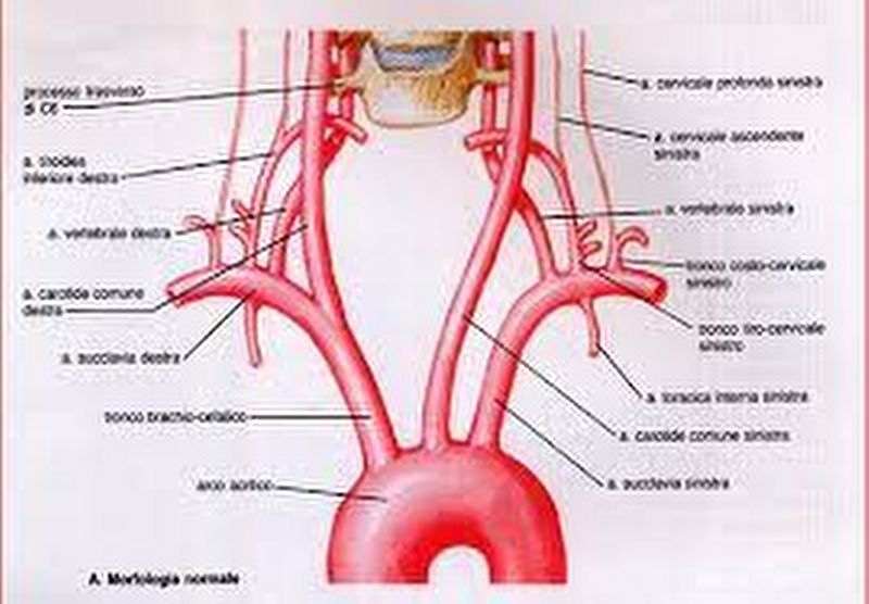 disseccazione arteria vertebrale